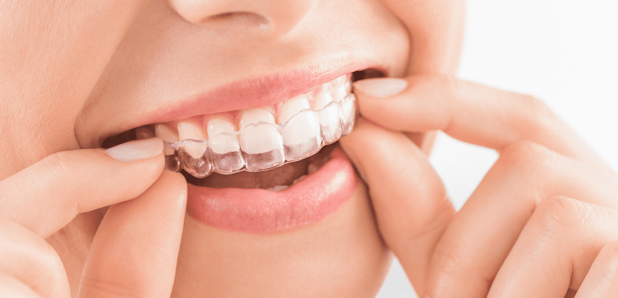 Featured image for “5 Strategies to Enjoy Coffee When Wearing Invisalign”
