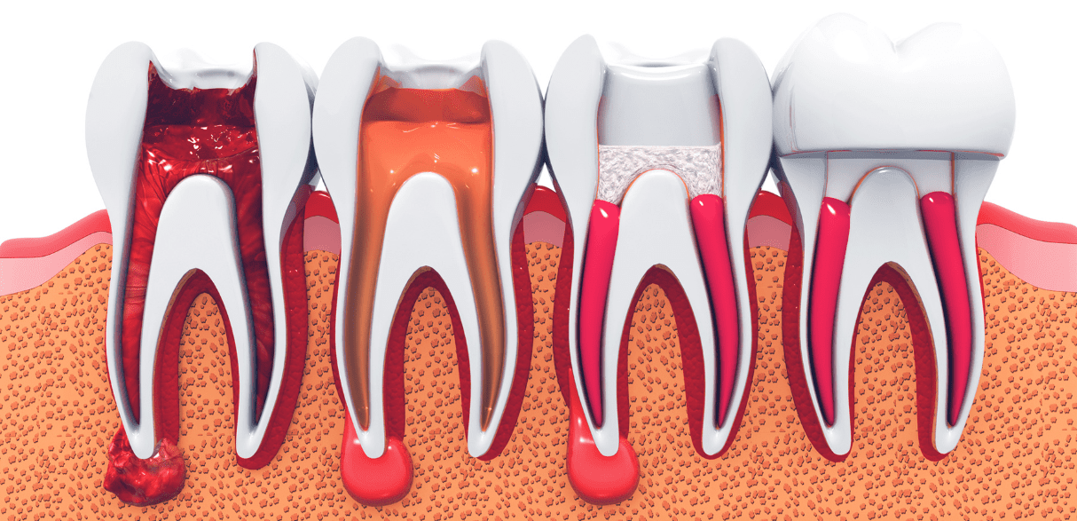 Featured image for “How to Relieve Pain After Root Canal Treatment?”