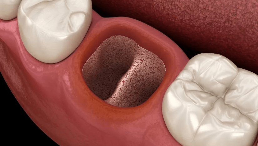 Featured image for “How to Avoid Dry Sockets After Your Wisdom Tooth Removal”