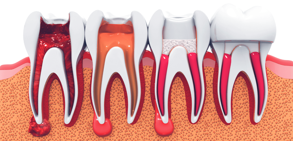 Featured image for “How to Relieve Pain After Root Canal Treatment?”